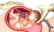 Nguyên nhân, dấu hiệu, cách điều trị và dự phòng vỡ tử cung
